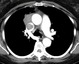 Contrast enhanced CT images at the level of the transverse aorta and left pulmonary artery show a lobulated mass in the right anterior mediastinum. The mass contains a coarse calcification and grows into the superior vena cava.  Note collateral circulation due to the obstruction of the superior vena cava. This is an example of Stage III disease.

